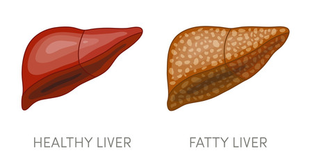 fatty liver and healthy liver