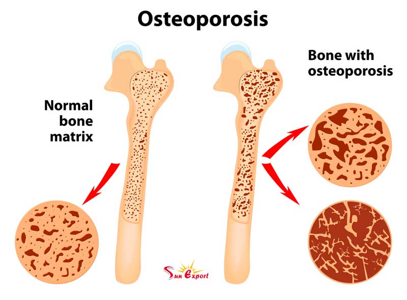 bones - What Do You Want to Know About Osteoporosis?