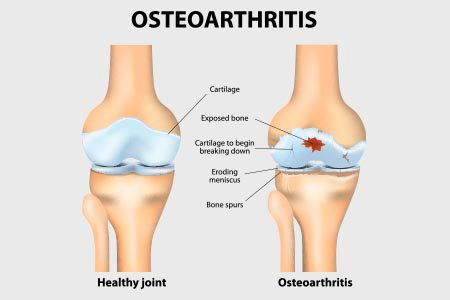 what is osteoarthritis - Osteoarthritis(OA): Symptoms, Treatments, and Causes