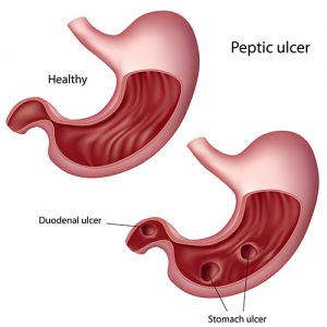 duodenal ulcer inline 300x300 - Diet for Stomach ulcer: Causes, symptoms, treatment